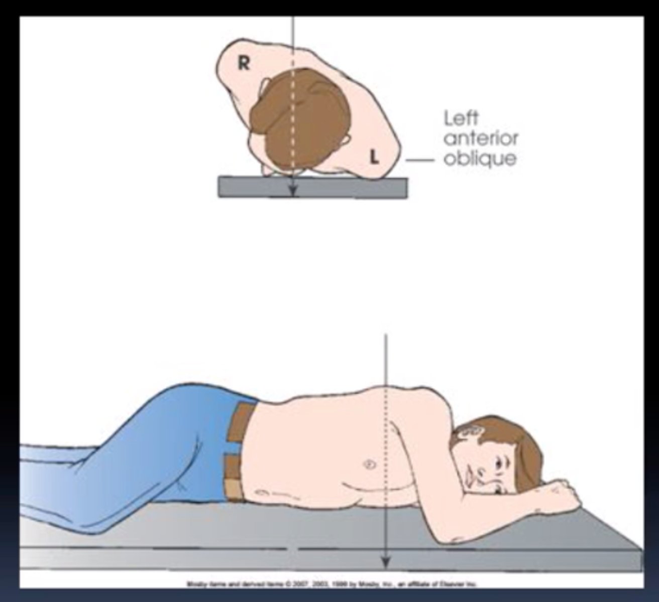 <p>Left Anterior Oblique</p>