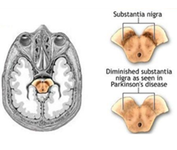<p>What is the principle of cell replacement therapy? Use the case study of Parkinson's disease to explain the strategy and its progress.</p>