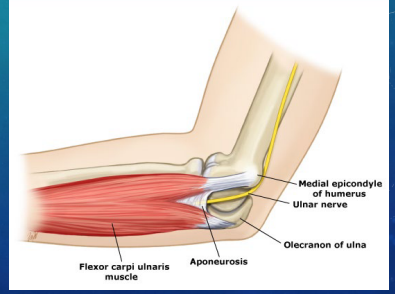 <p><strong>Cubital Tunnel Syndrome: Background</strong></p><p>-______ nerve compression in the ______ tunnel along the medial elbow. The nerve is compressed by the _____ ______ ulnaris </p><p>-Caused by trauma, leaning on elbow, prolonged _________, and joint pathologies </p>