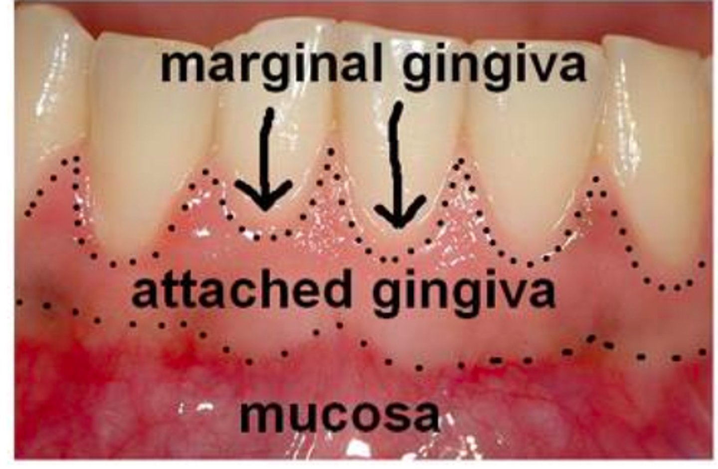 <p>firmly bound to underlying alveolar bone</p>