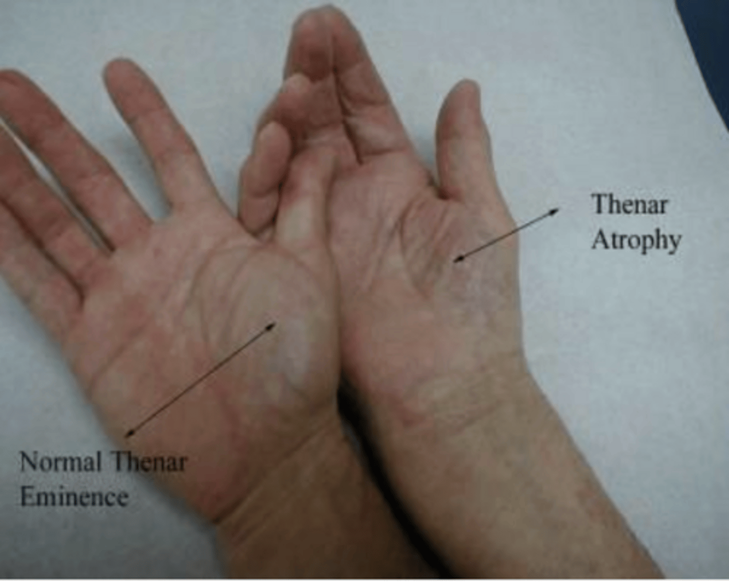 <p>Thenar atrophy, decreased sensation over median nerve distribution to sharp/dull and light touch. Decreased strength to thumb opposition</p>