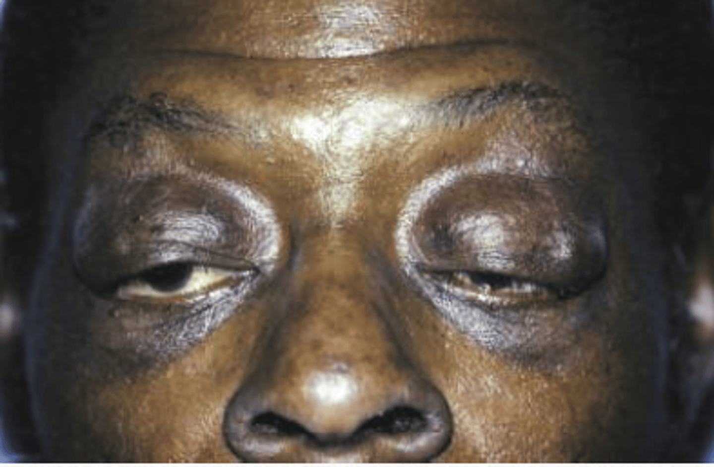 <p>• Double lip</p><p>• Blepharochalasis</p><p>• Nontoxic thyroid enlargement</p>