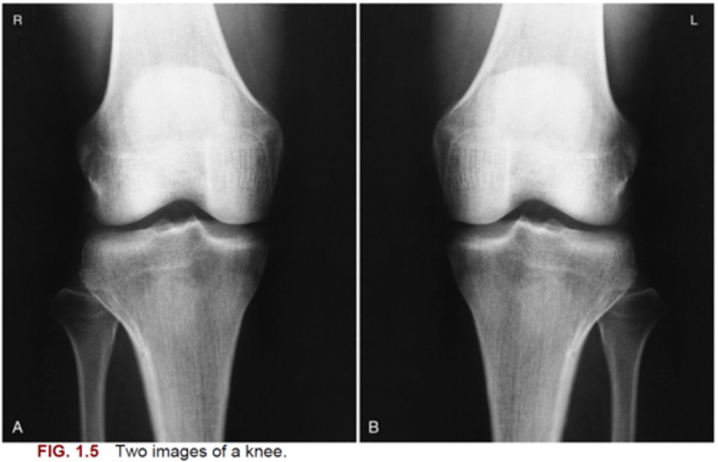 <p>74. Fig. 1.5 shows two images of an anteroposterior (AP) right knee radiograph. Which image (A or B) is correctly displayed?</p>