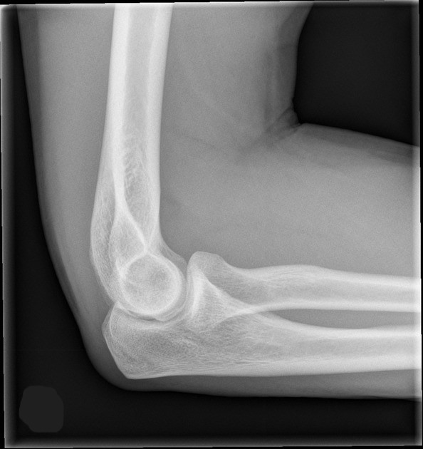 <p>Based <em>solely</em> on how the image was oriented when sent, is this a right or a left elbow?</p>