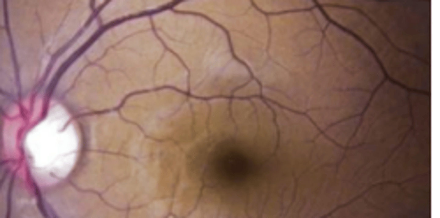 <p>autosomal recessive congenital stationary night blindness having a 2-12 hours delay in dark adaptation. The fundus appears golden brown when light adapted and normal colored when dark adapted (Mizuo phenomenon).</p>