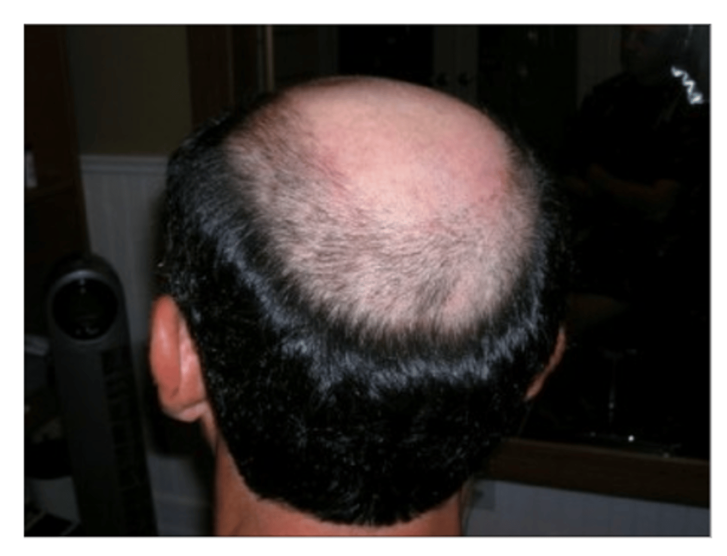 <p>Baldness is a dominant trait in males and females must receive two recessive alleles to get the trait<br><br>In the presence of high levels of testosterone the gene is expressed so more men than women experience</p>
