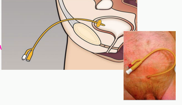 <p><strong>_________ Catheter</strong></p><p>-Inserted into the bladder from the outside</p><p>-Typically more _____________ than an indwelling catheter and is less likely to cause an ___________</p><p>-Good option for patients who develop urethral ________ from urethral _____</p>