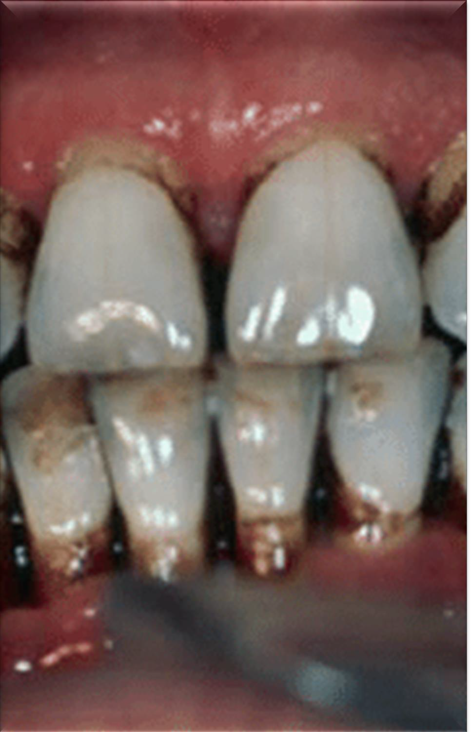 <p>Why do root surfaces (cementum and dentin) risk tooth wear during polishing?</p>