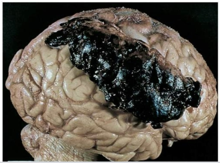 subdural hematoma