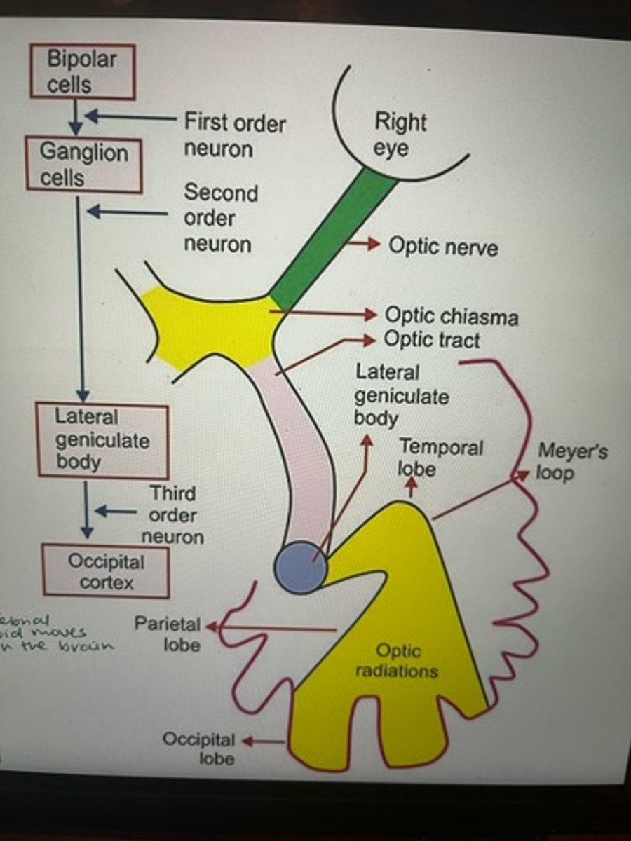 <p>1) Light enters the Right Eye</p><p>2) Bipolar Cells and Ganglion Cells process the signal</p><p>3) First and Second Order Neurons transmit the signal</p><p>4) Optic Nerve carries information from the eye</p><p>5) Optic Chiasma: Nerves cross over</p><p>6) Optic Tract carries information onward</p><p>7) Lateral Geniculate Body (LGB) processes information (Third Order Neuron)</p><p>8) Optic Radiations carry information to the cortex</p><p>9) Meyer's Loop (part of radiations) loops around the temporal horn</p><p>10) Occipital Cortex interprets the visual information</p>
