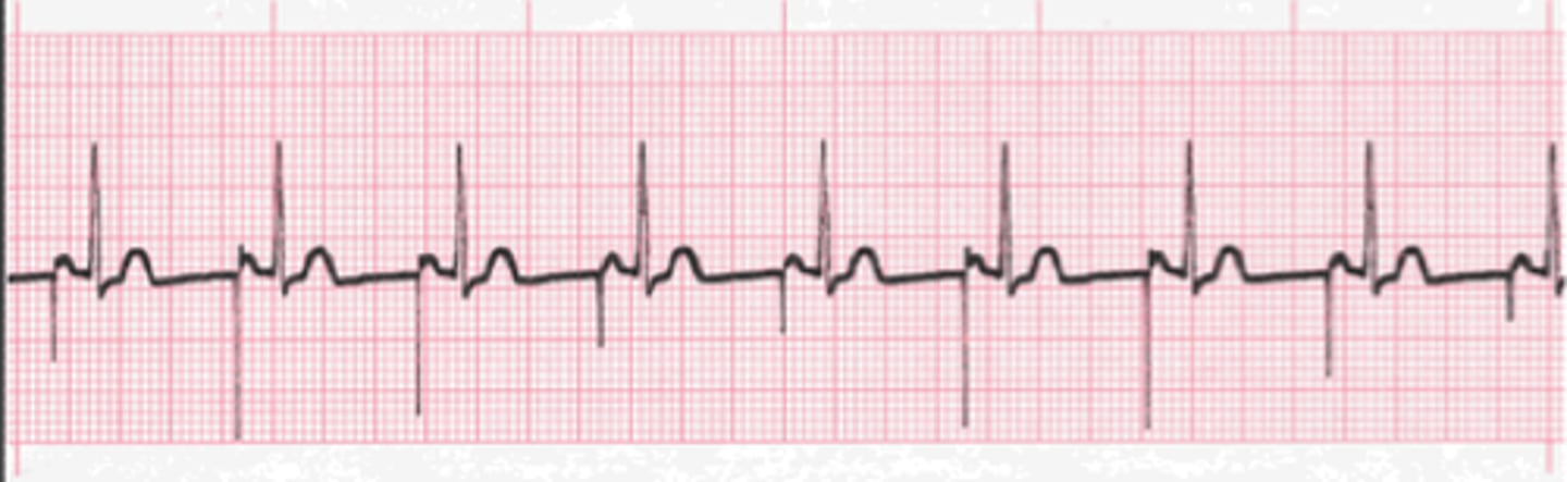 <p>Which Arrythmia is this?</p>