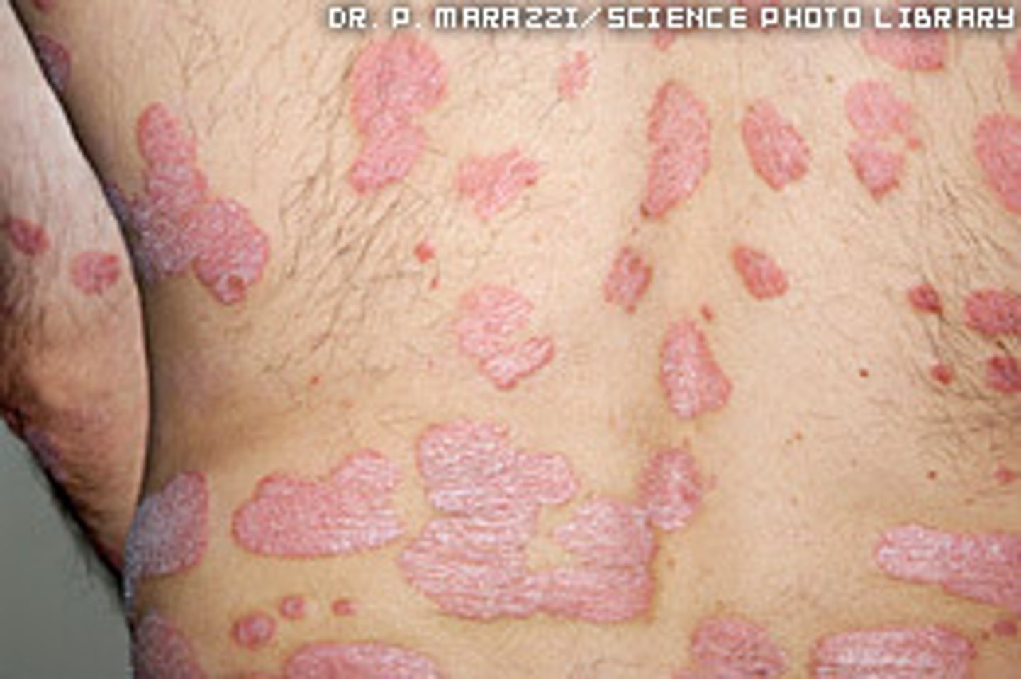 <p>-immune problem that causes skin cells to grow faster than usual</p><p>-rash with itchy, scaly patches</p><p>-knees, elbows, trunk, scalp</p><p>-cyclic rashes that flare up then subside</p><p>-most common type: plaque psoriasis</p><p>-treatment: topical steriods, vitamin, D, retinoids, etc</p>