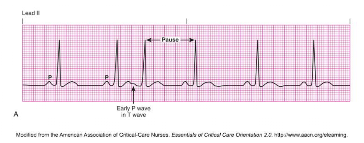 <ol><li><p>premature ectopic beat from atrial tissues followed by a non-compensatory pause</p></li><li><p>P waves often looks different</p></li><li><p>it is mostly harmless just an indicated need for monitoring for patient with weak or diseased heart → it is often referred to as palpitations with no change in cardiac output - no treatment are indicated</p></li></ol><p></p>
