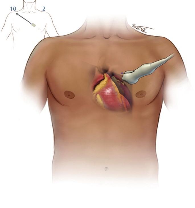 Towards the patient’s right shoulder. Image the heart inside the body.