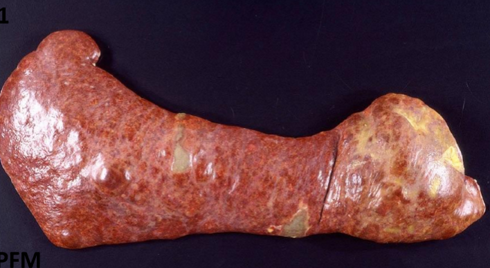 <p>What type of histiocytic sarcoma is this (+ ddx)</p>