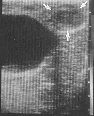 <p>If ultrasound waves travel through a structure which is less attenuating (absorbing) or a more transparent structure, the tissue of interest behind it may be shrouded due to more waves being transmitted through and hence reflecting back and reaching the scanner head. This causes false hyperechoic (white) regions to form.</p>