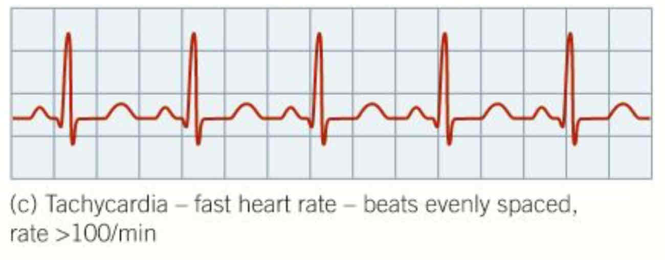 <ul><li><p>heartbeat <strong>&gt;100min^-1</strong></p></li><li><p>normal after excerise, frightened etc</p></li><li><p>if abnormal may be caused by problems in electrical control of heart, may need to be treated by medication or surgery</p></li></ul>