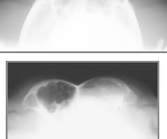 <p><span><span>What view is used to look at the frontal sinus?</span></span></p>