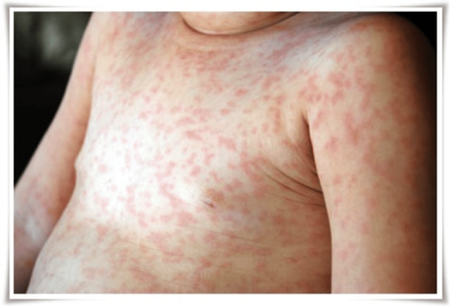 <p>flat, reddened lesions that can be differentiated by color</p>