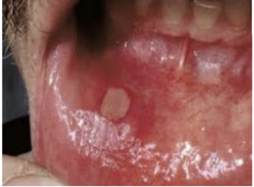 <p>The main cause of oral ulcers that are painful, localized, shallow, round/oval with a yellowish adherent exudate centrally that are more common in childhood/adolescence and typically heal spontaneously within 10-14 days.</p>