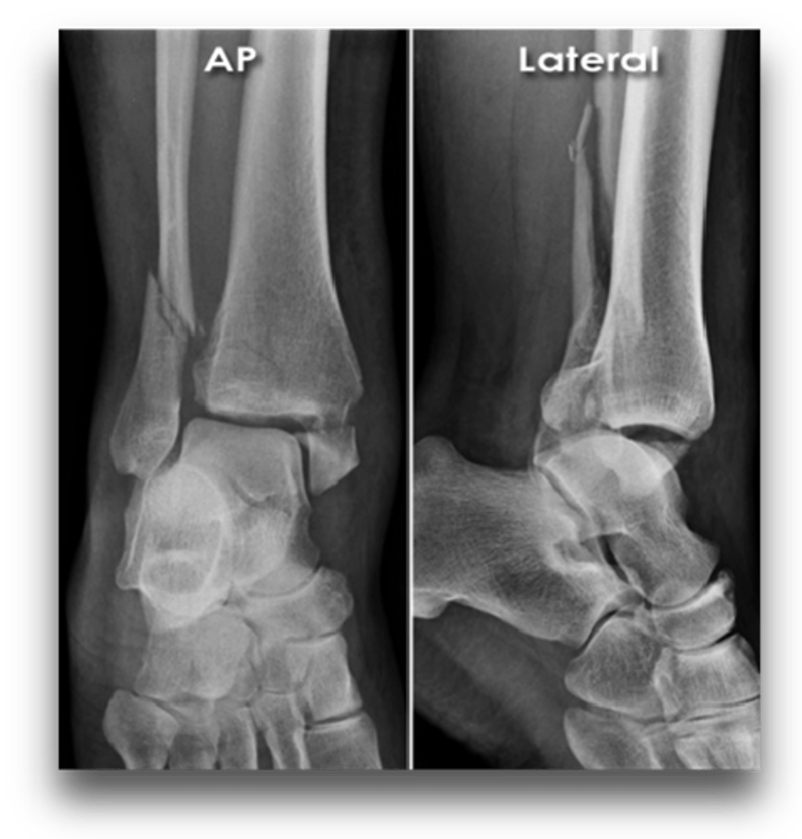 <p>Trimalleolar fx</p>