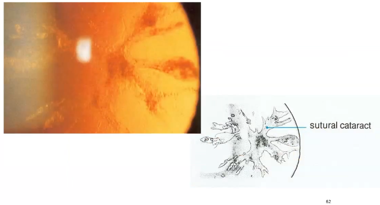 <p>affects space where lens fibres are supposed to meet </p>