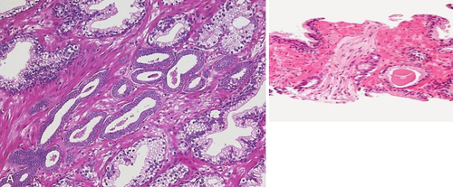 <p>- Hyperplasia and papillary proliferation of the glandular tissue</p><p>- Stromal hyperplasia</p><p>without infiltration of surrounding tissues</p>