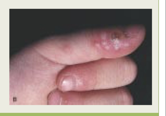 What is a HSV-1 infection of the finger?
