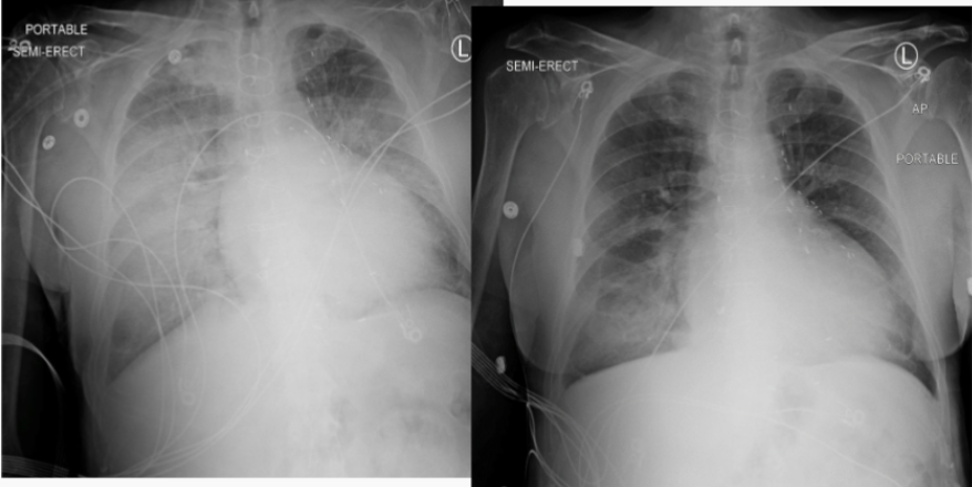 <p>What was the patient’s original dx (left) and what caused improvement (right)?</p>
