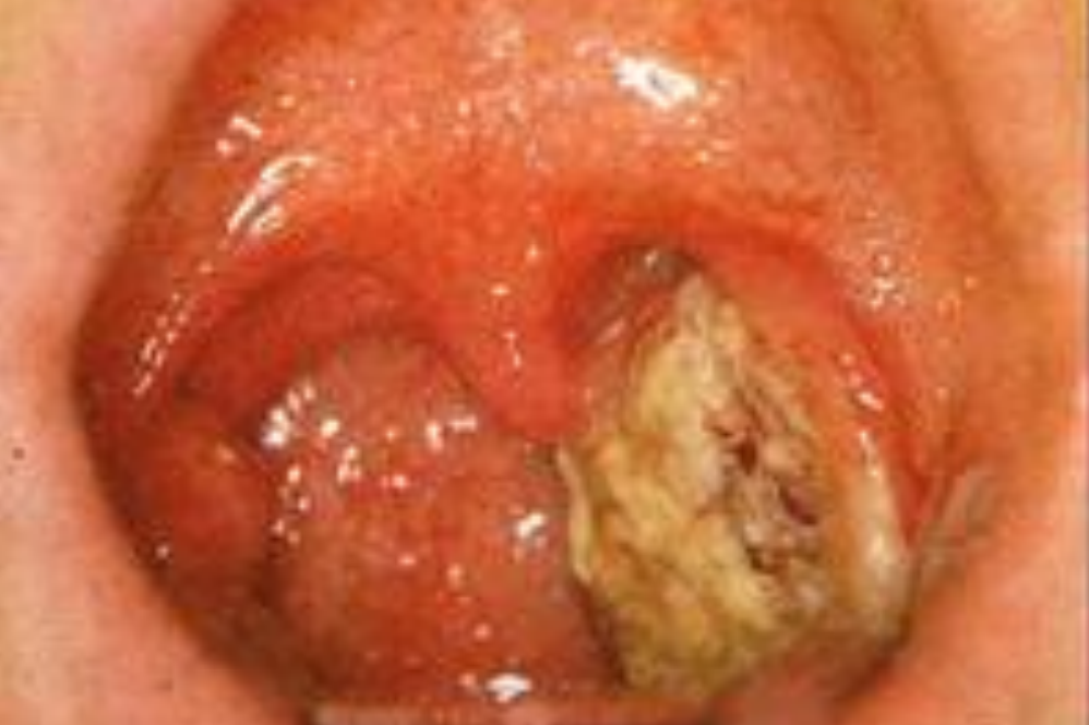 <p>Identify the descriptive term for this lesion</p>
