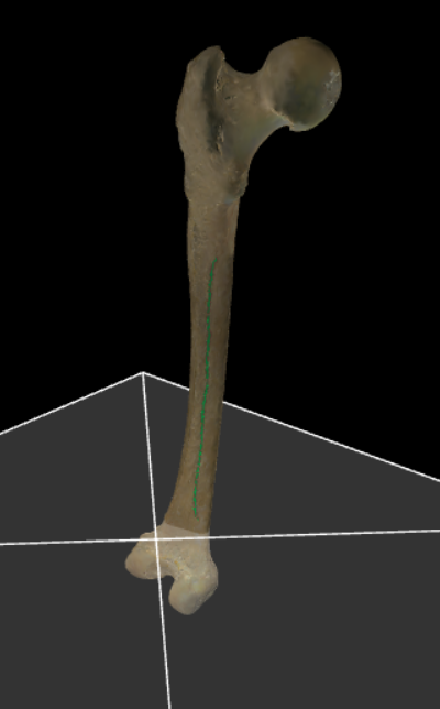 <p>De binnenlip van de linea aspera.</p>