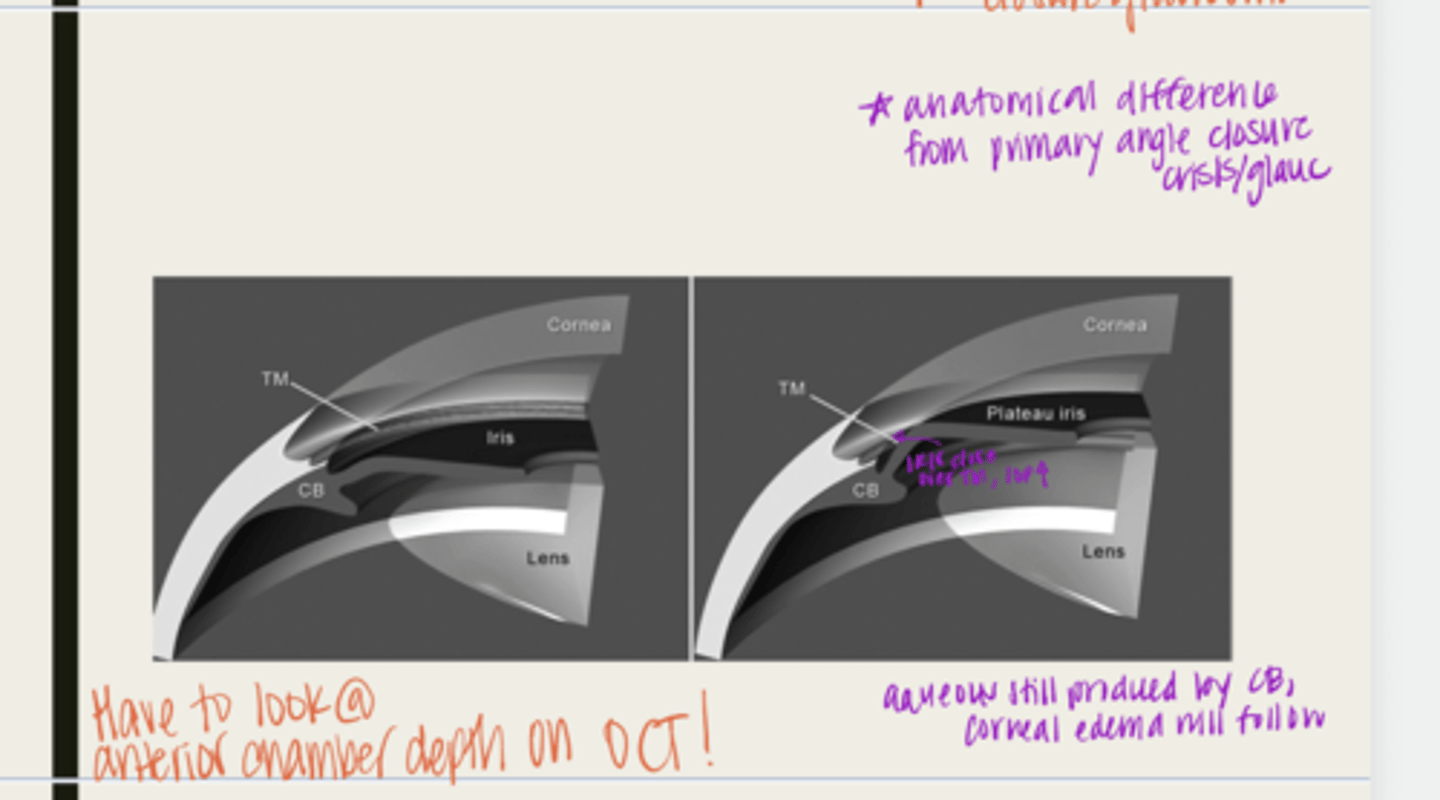 <p>What are the symptoms of plateau iris configuration?</p>