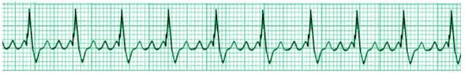 <p>Flutter atrial</p>