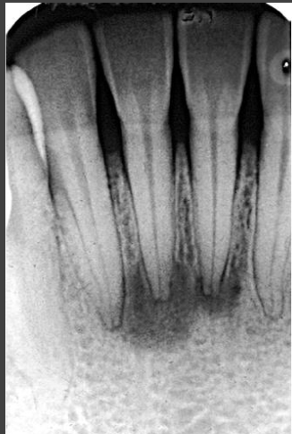 <p>What is Periapical Cemento-Osseous Dysplasia?</p>