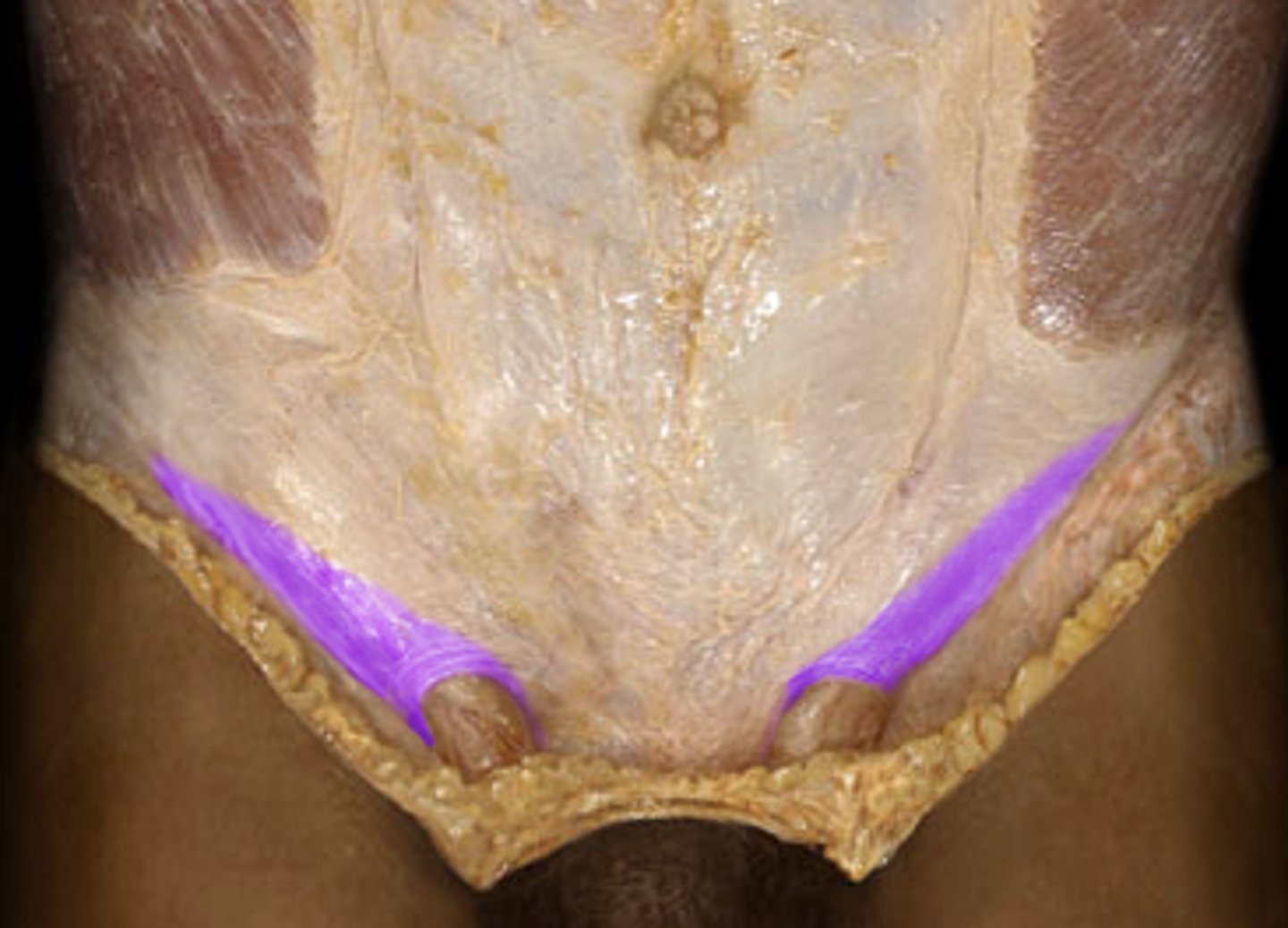 <p>V line</p><p>-goes from ASIS to pubic symphysis, made of collagen fibers, aponeurosis of inferior part of external oblique (anatomical landmark)</p><p>above it=hip</p><p>below it=thigh</p>