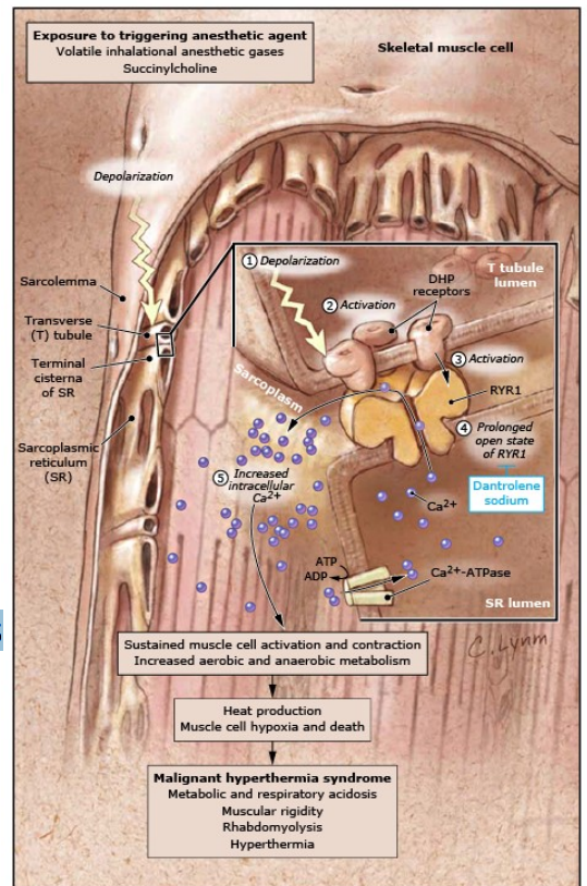 <p>Malignant Hyperthermia</p><p>(Tx. Target Ryanodine Receptor)</p>