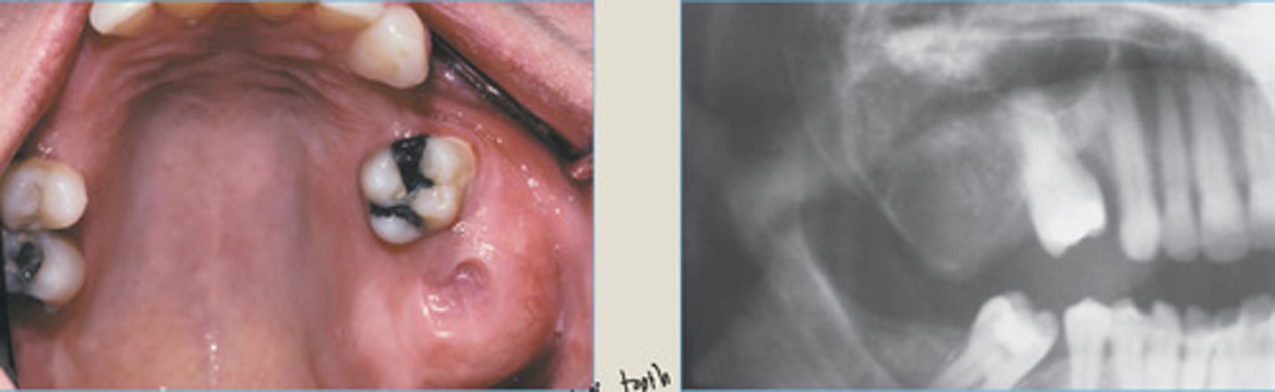 <p>Enlargement of post. maxilla</p><p>More discrete edges</p><p>RIGHT: mixed radiolucent and radiopaque lesion expanding into post MX</p>