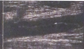 <p>Describe the condition in this image</p>