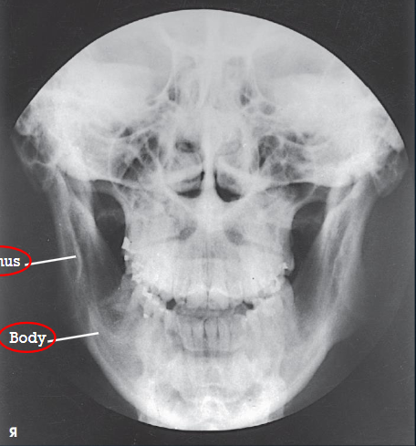 <ul><li><p>mandibular body and rami</p></li><li><p>central part of body not well shown due to superimposed spine</p></li><li><p>demonstrates medial or lateral displace ment of fragments in fractures of the rami</p></li><li><p>no rotation or tilt:</p><ul><li><p>symmetric mandibular body and rami</p></li><li><p>MSP of head aligned with long axis of collimated field</p></li></ul></li><li><p>condylar processes</p></li></ul><p></p>