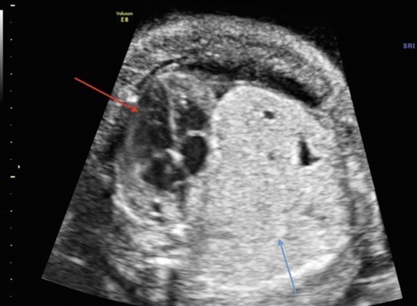 <p>Very bright lung parenchyma with few/no cysts</p><p>Lungs often have mass effect</p><p>Poorest prognosis - poor lung function</p>