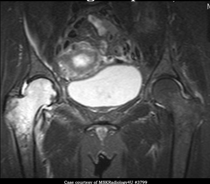 <p>what is seen here for this case of regional osteoporosis?</p>