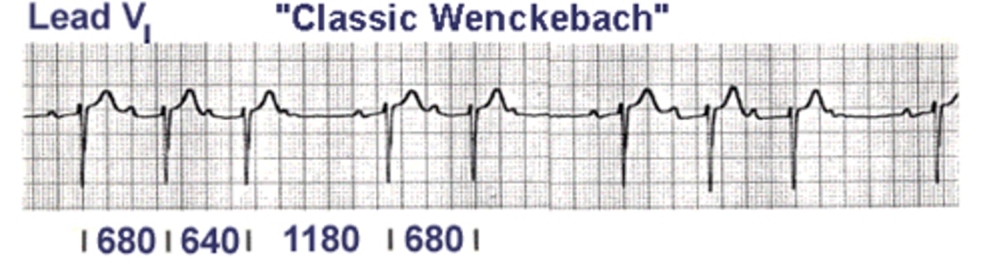 <p>WENCHEBACH AV BLOCK</p>