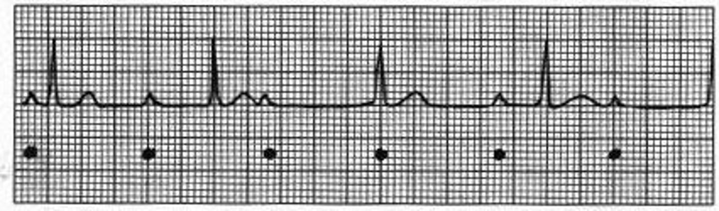 <p>No communication between atria and ventricles</p><p>DANGEROUS</p>