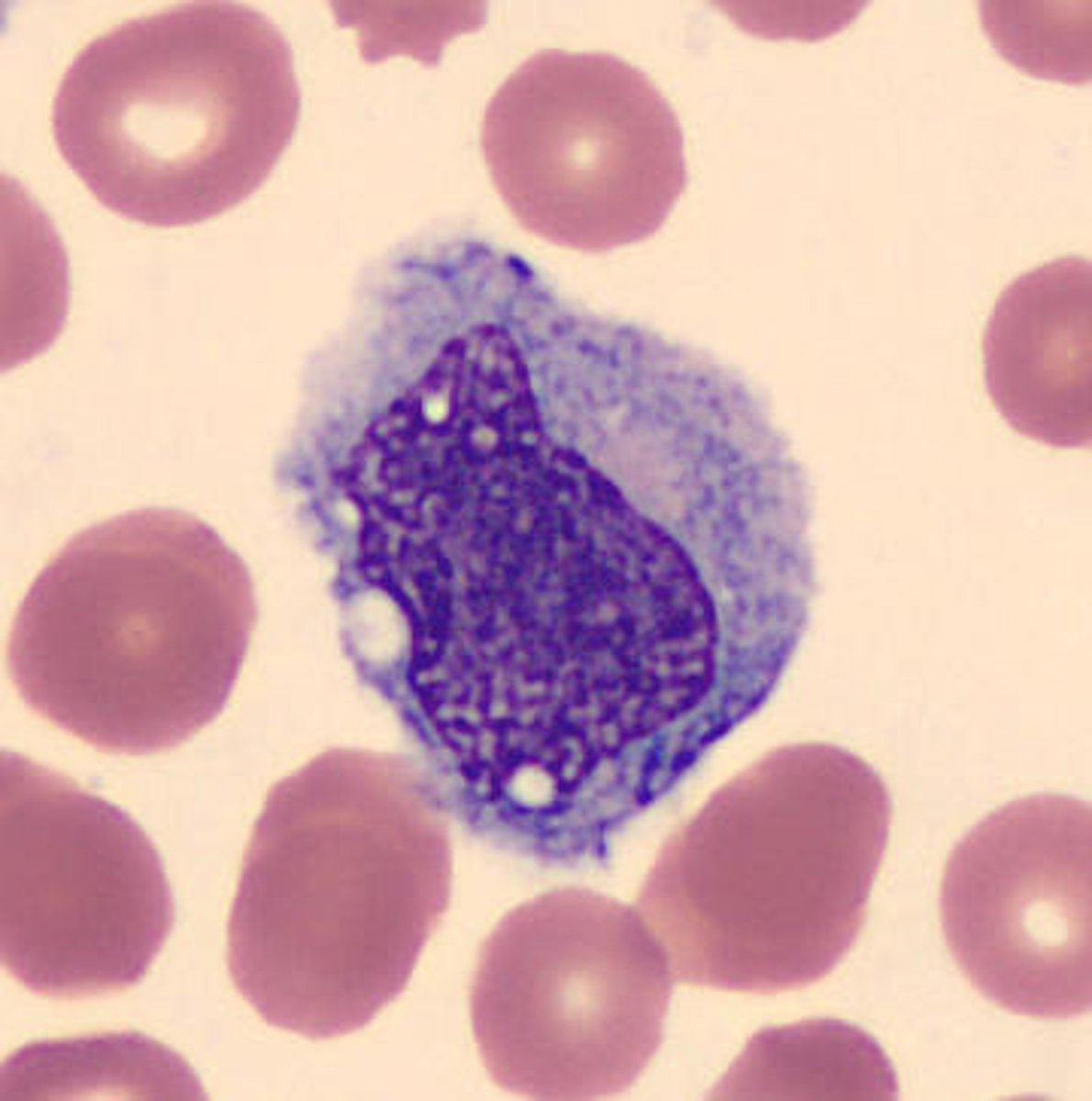 <p>- Horseshoe-shaped, indented</p><p>- Round to oval nucleus</p><p>- Nuclear folding sometimes</p><p>- Vacuoles present</p><p>- Lacy chromatin</p><p>- Gray, gray-blue, ground glass appearance</p><p>- Fine, pale pink, dust-like granules evenly dispersed</p><p>- 4:2-2:1 N:C ratio</p>