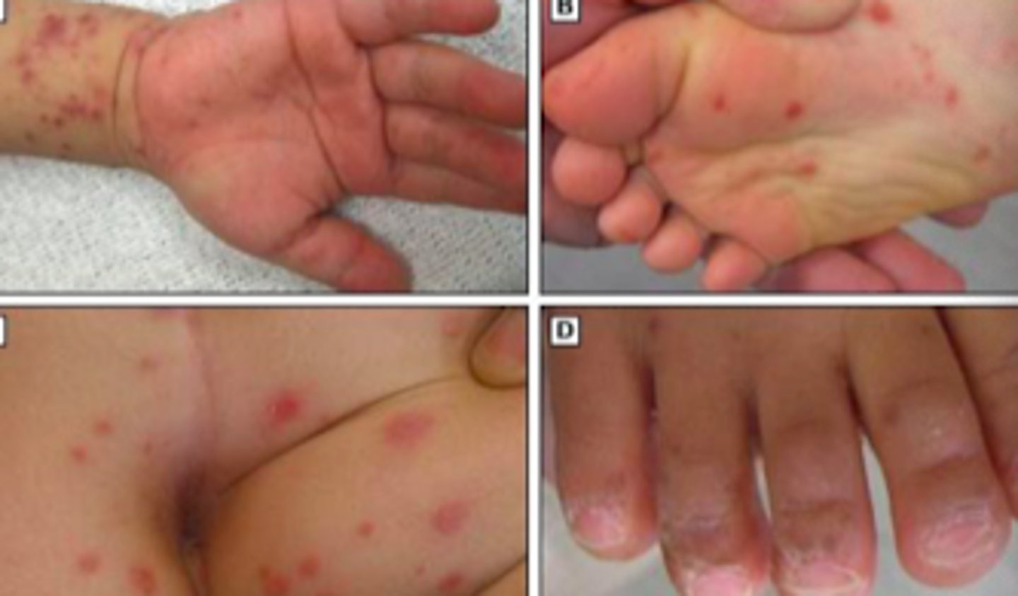 <p>Exanthems:</p><p>Subjective:</p><p>- mouth/throat pain (verbal children)</p><p>- Refusal to eat (nonverbal children)</p><p>- Low fever</p><p>Absent prodromal symptoms! BUT</p><p>- If they are there, they have fever, fussiness, abdominal pain, emesis, diarrhea</p>