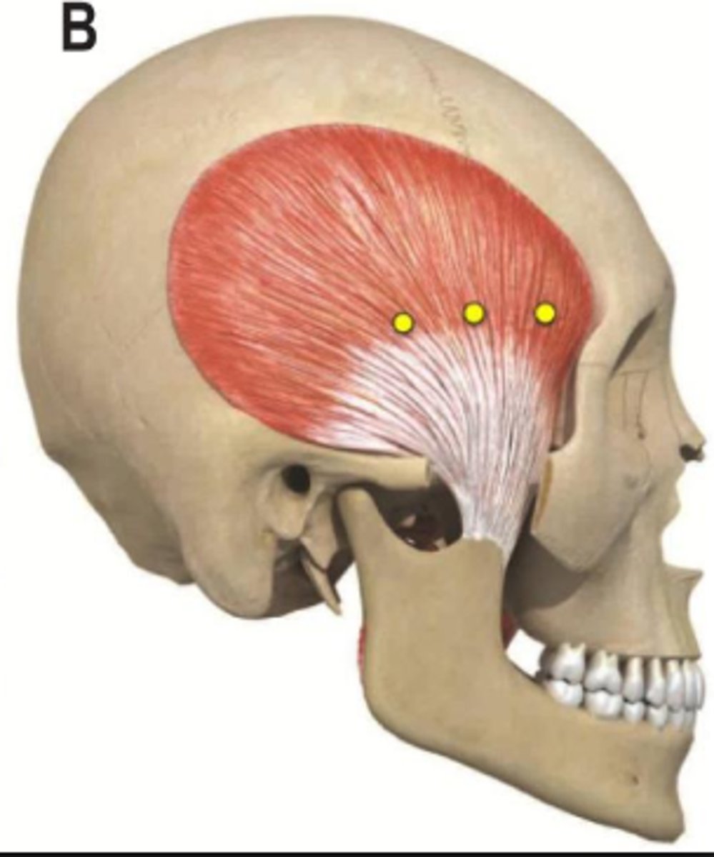<p>coronoid process and ramus of mandible</p>