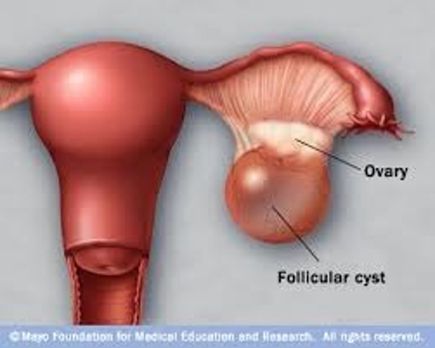 <p>a fluid filled sac in an ovary</p>