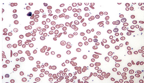 <p>name 1 major abnormal cell</p>