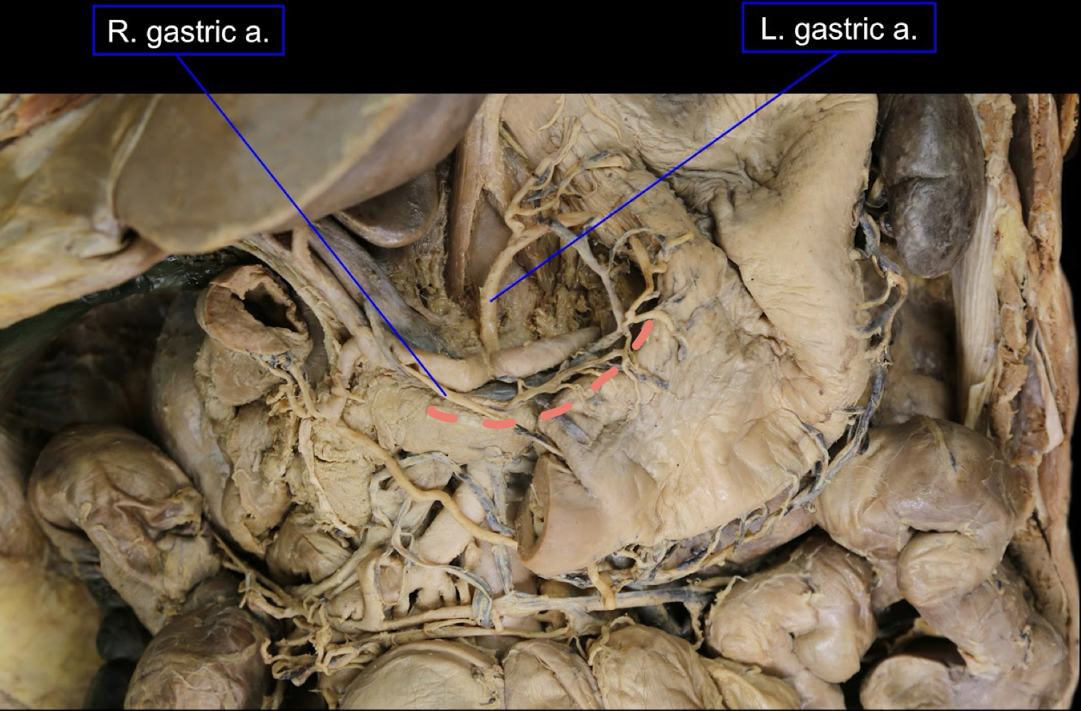 <p>A). lesser curvature of the stomach<br>B). right and left gastric arteries</p>