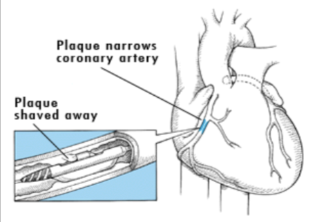 <ul><li><p>the catheter tip contains a tube-like structure w/ a window in it</p></li><li><p>the tube rotates to cut or shave off the plaque</p></li><li><p>the plaque is collected in the tube</p></li></ul><p></p>